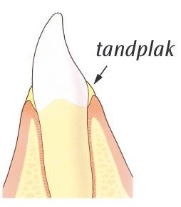 Bacteriën - Tandplak