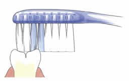 Fluoridemondspoelmiddel Ongesealde kies 2forteeth