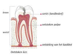 Wortelkanaalbehandeling