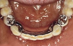 Frameprothese in wording