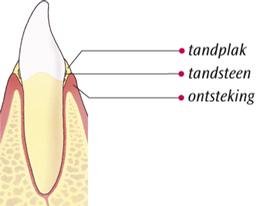 Ontstoken tandvlees