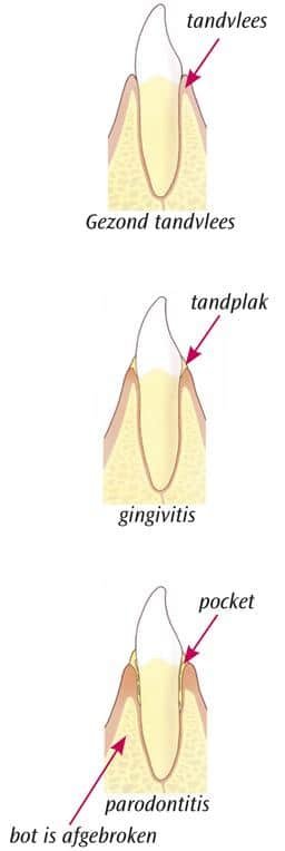 diabetes gingivitis parodontitis